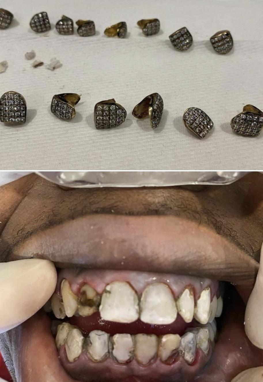 Are Grillz Bad for Your Teeth? Everything You Need to Know