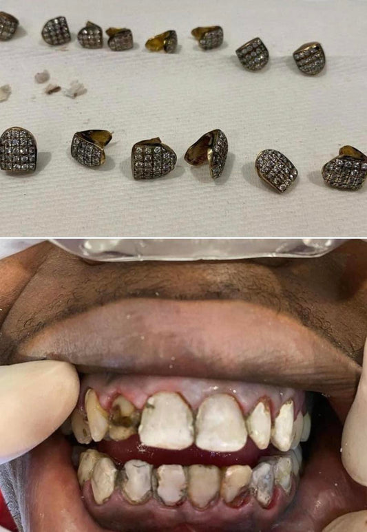 Are Grillz Bad for Your Teeth? Everything You Need to Know