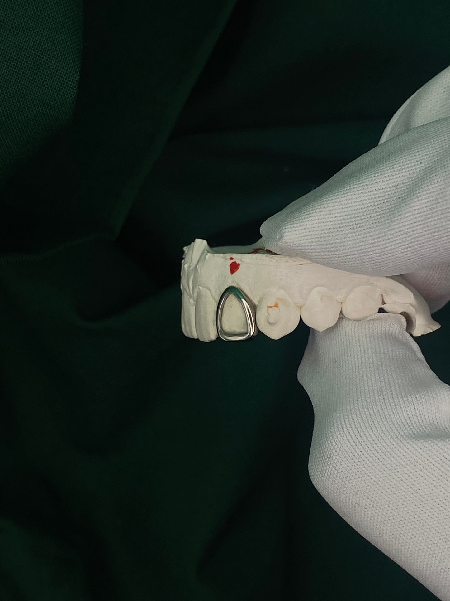 Lateral Incisor Window Cap